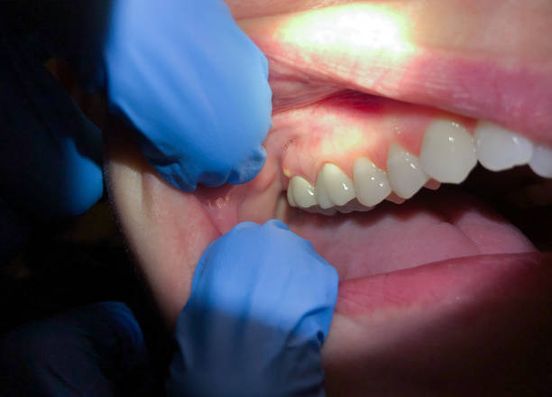 Best Emergency Dental Care for Abscessed Tooth in Potosi, MO
